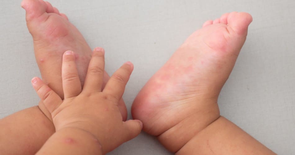 Bild der Hand-Fuß-Mund-Krankheit bei Kindern.