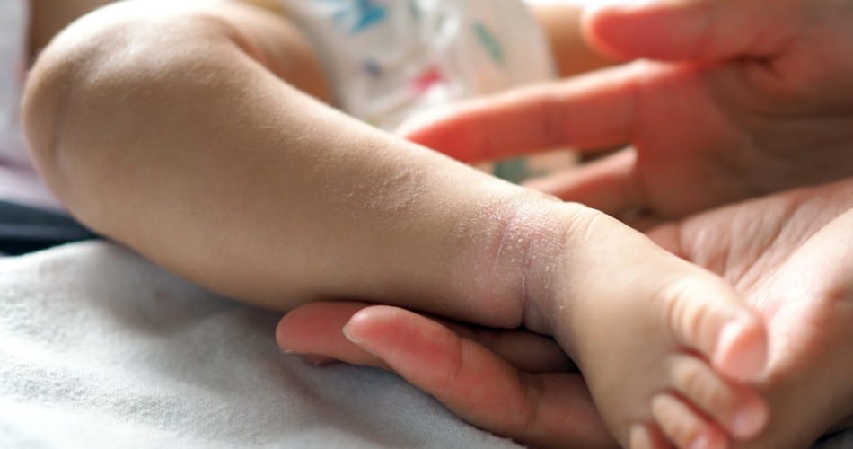 Neurodermitis bei Babys
