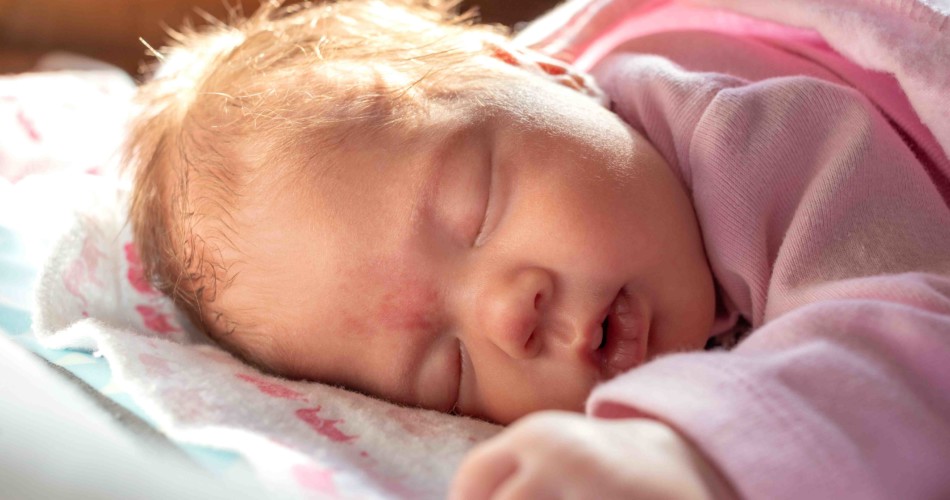 Ein Baby mit einem Storchenbiss (Engelskuss) auf dem Kopf.