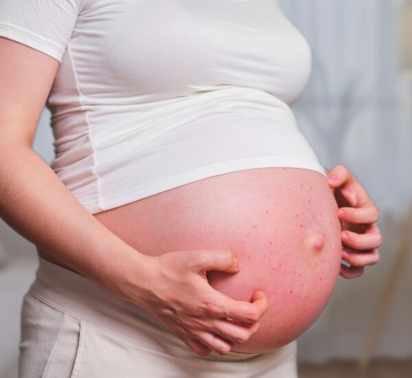 Hausmittel bei Schwangerschaftsdermatose