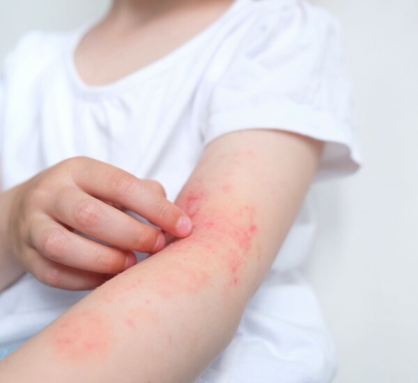 Duftstoffallergie bei Kindern erkennen.