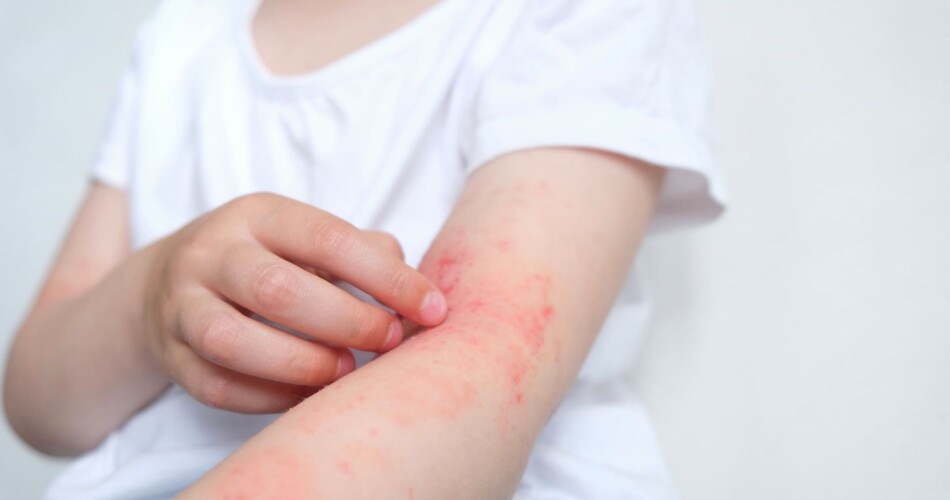 Duftstoffallergie bei Kindern erkennen.